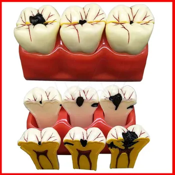 4 krát Protézy Ochorenia Zubov Model Kazu Rozkladu Zubného Kazu Model Pre Zubné Lekárske Demo Komunikačné Vyučovanie