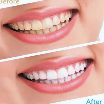 2 ks/pack White Smaile Klinike Dental Bieliace Pásiky na Bielenie zubov Pásy Zubov Bielenie Belšie Whitestrips Nastaviť