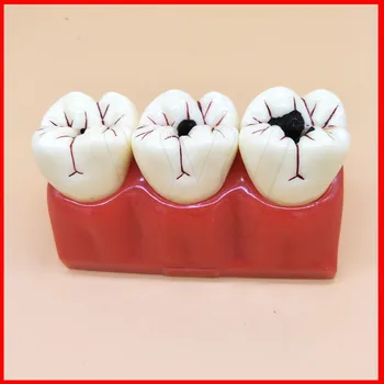 4 krát Protézy Ochorenia Zubov Model Kazu Rozkladu Zubného Kazu Model Pre Zubné Lekárske Demo Komunikačné Vyučovanie