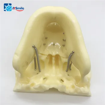Zubné M2016 Plastové Implantát Praxi Model Zubné Model